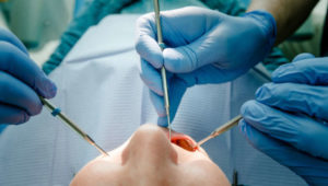 Zahnarzt-Albtraum! Todesdrama um jungen Mann bei Wurzelbehandlung