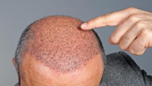 Haarausfall: Wann eine Haartransplantation infrage kommt